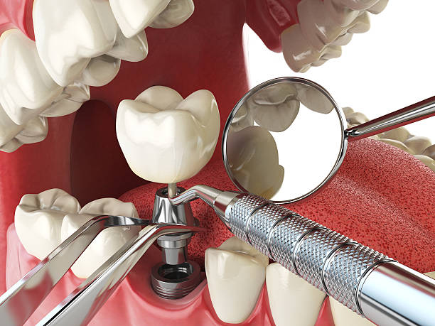 Best Emergency Root Canal Therapy in Lyndonville, VT